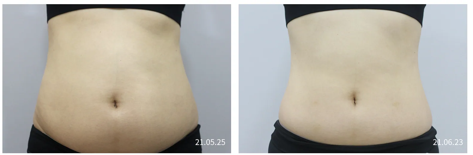Minus Fat body front view of the abdomen, before and after