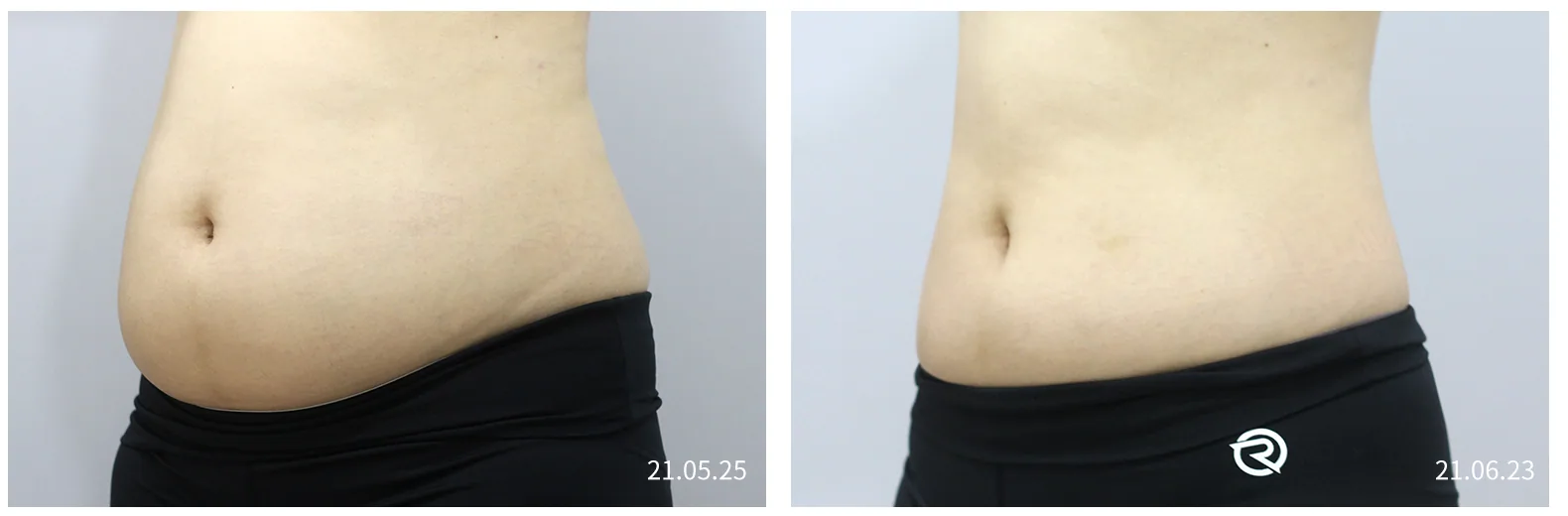 Minus Fat body side view of the abdomen, before and after