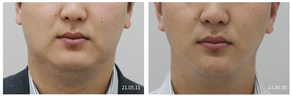 Minus Fat face front view, before and after