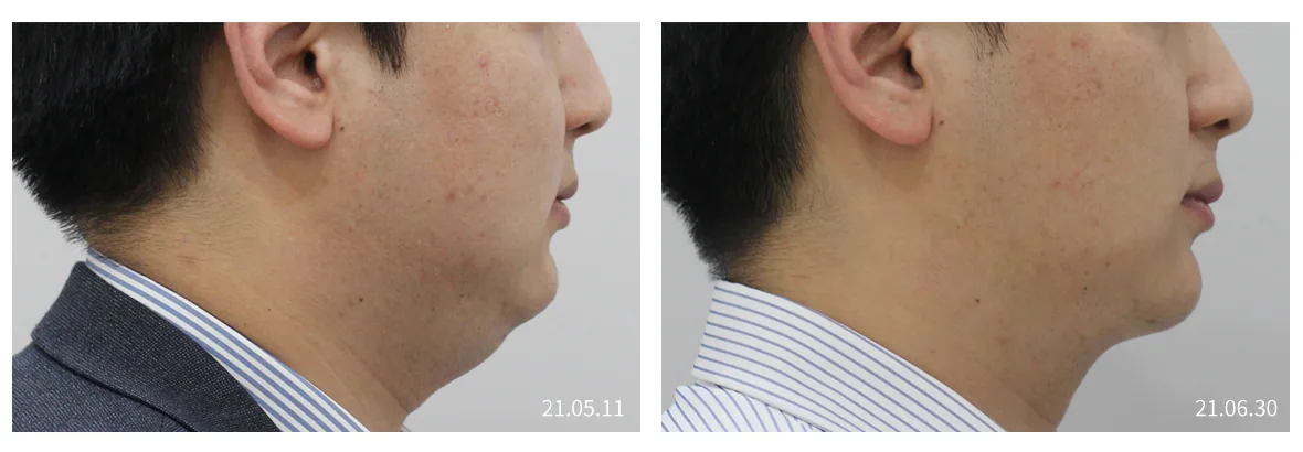 Minus Fat face side view, before and after, double chin and jawline