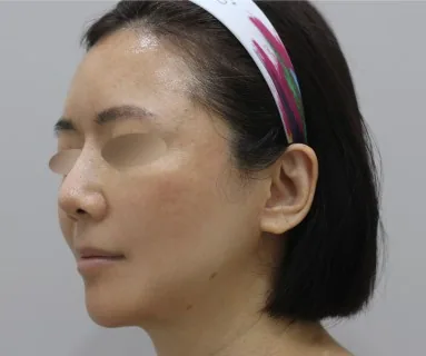 After: Leeds Turn thread lifting + Minus Pet + Rejuran Healer, patient at Time Return Clinic Seoul