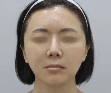 After: Leeds Turn thread lifting + Minus Pet + Rejuran Healer, patient at Time Return Clinic Seoul