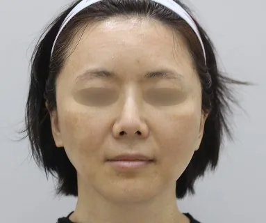 Before: Leeds Turn thread lifting + Minus Pet + Rejuran Healer, patient at Time Return Clinic Seoul