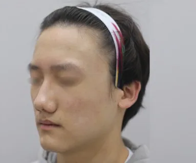 After: All-in laser (acne, scars, redness), patient at Time Return Clinic Seoul
