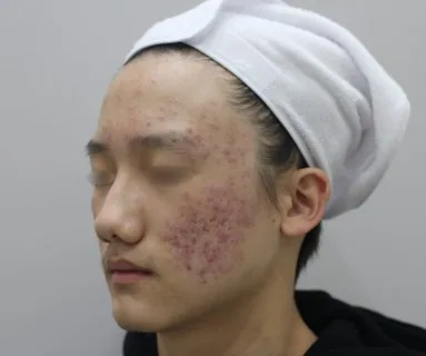 Before: All-in laser (acne, scars, redness), patient at Time Return Clinic Seoul