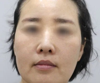 After: All-in laser (pigment) + Rejuran Healer, patient at Time Return Clinic Seoul