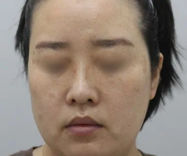 Before: All-in laser (pigment) + Rejuran Healer, patient at Time Return Clinic Seoul
