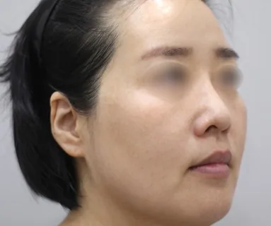 After: All-in laser (pigment) + Rejuran Healer, patient at Time Return Clinic Seoul
