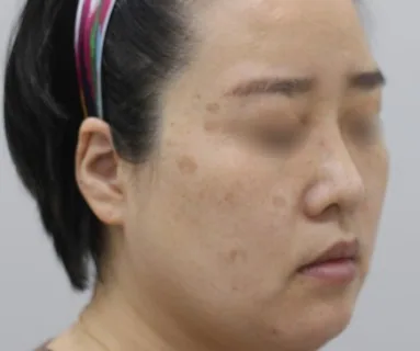 Before: All-in laser (pigment) + Rejuran Healer, patient at Time Return Clinic Seoul
