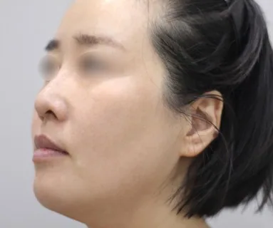 After: All-in laser (pigment) + Rejuran Healer, patient at Time Return Clinic Seoul