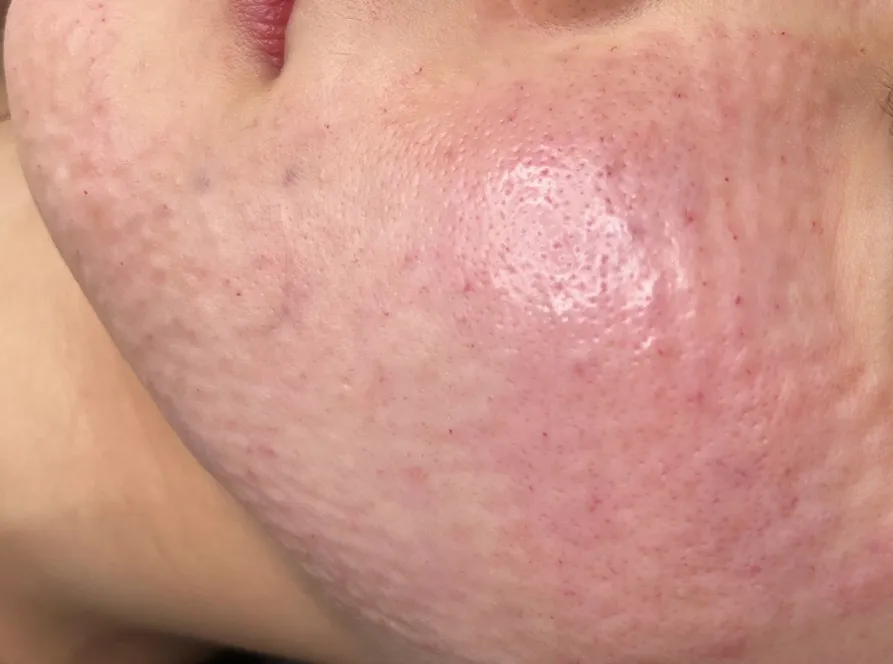 Small raised bumps on the cheek and jawline right after Rejuran injections at Time Return Clinic (1)