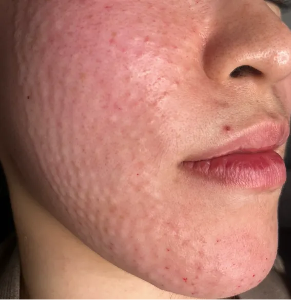 Small raised bumps on the cheek and jawline right after Rejuran injections at Time Return Clinic (2)