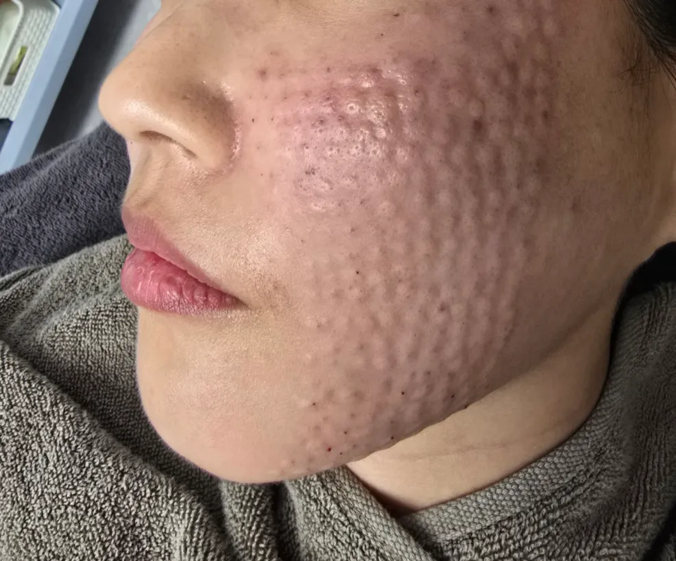 Small raised bumps on the cheek and jawline right after Rejuran injections at Time Return Clinic (3)