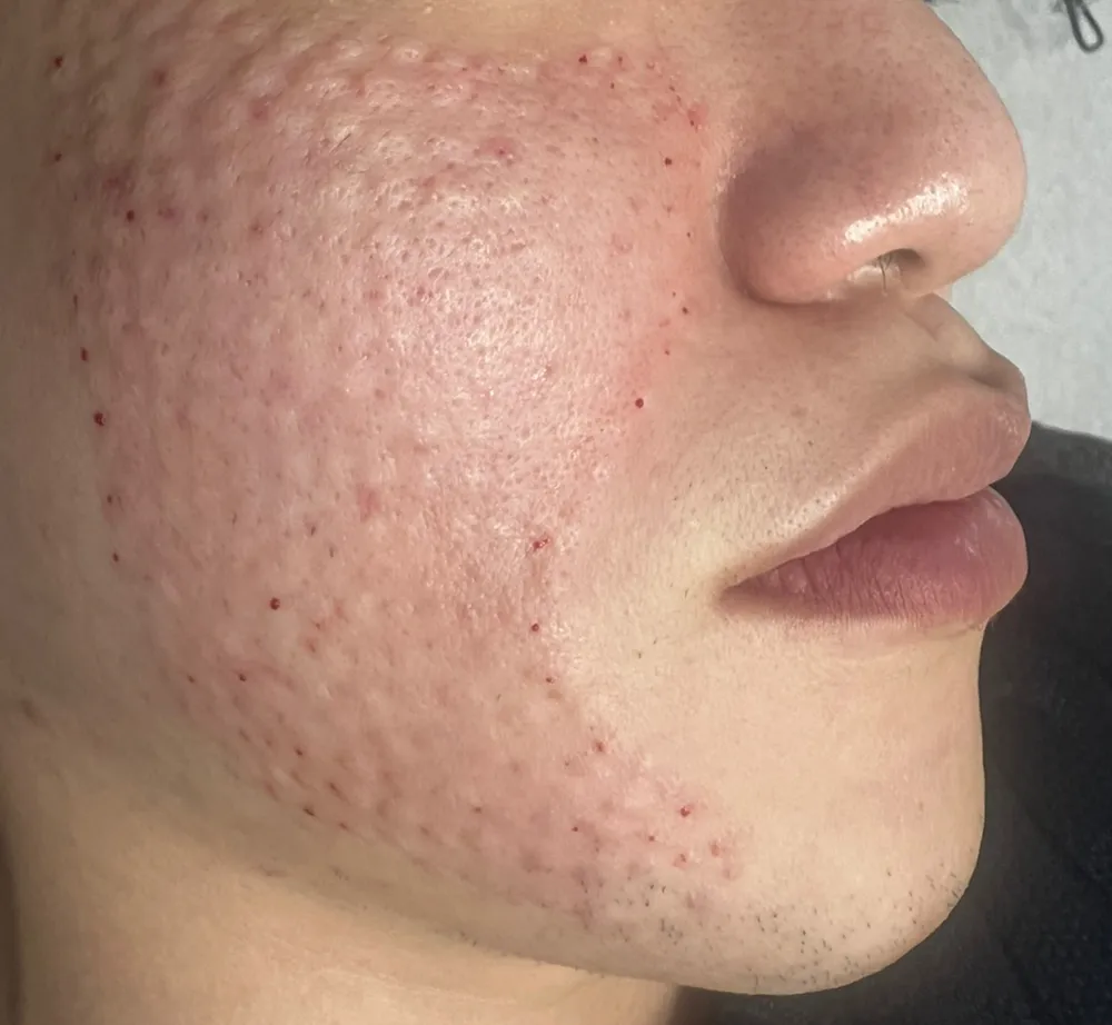 Small raised bumps on the cheek and jawline right after Rejuran injections at Time Return Clinic (4)