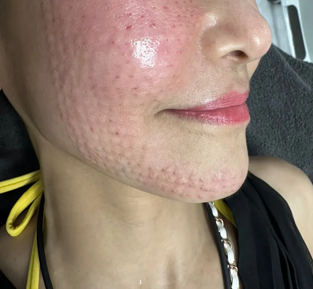 Small raised bumps on the cheek and jawline right after Rejuran injections at Time Return Clinic (5)