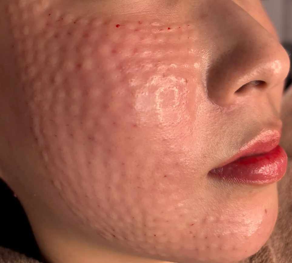 Small raised bumps on the cheek and jawline right after Rejuran injections at Time Return Clinic (6)