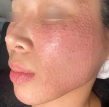 Small raised bumps on the cheek and jawline right after Rejuran injections at Time Return Clinic (7)