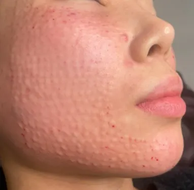 Small raised bumps on the cheek and jawline right after Rejuran injections at Time Return Clinic (8)