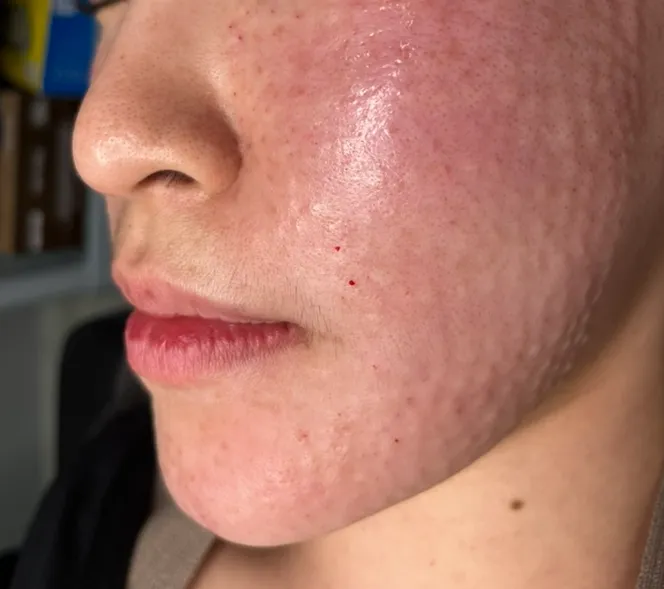 Small raised bumps on the cheek and jawline right after Rejuran injections at Time Return Clinic (9)