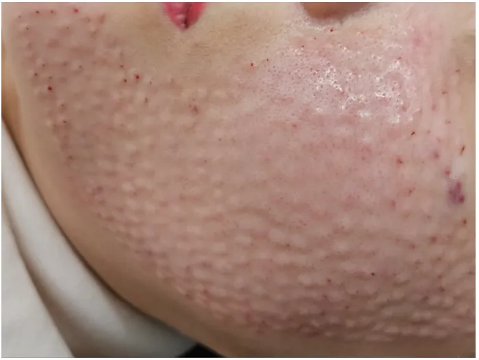 Small raised bumps on the cheek and jawline right after Rejuran injections at Time Return Clinic (10)