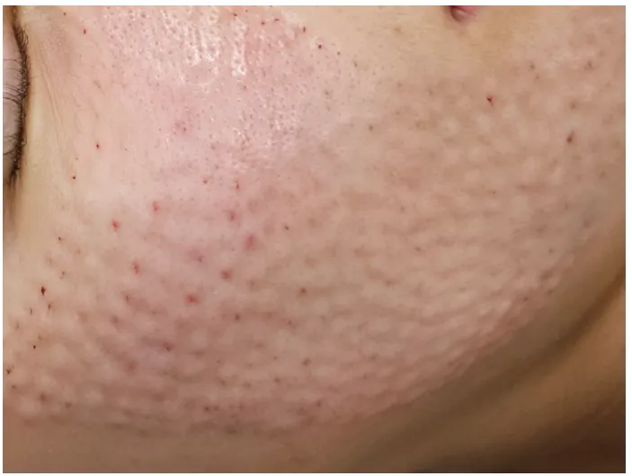 Small raised bumps on the cheek and jawline right after Rejuran injections at Time Return Clinic (11)