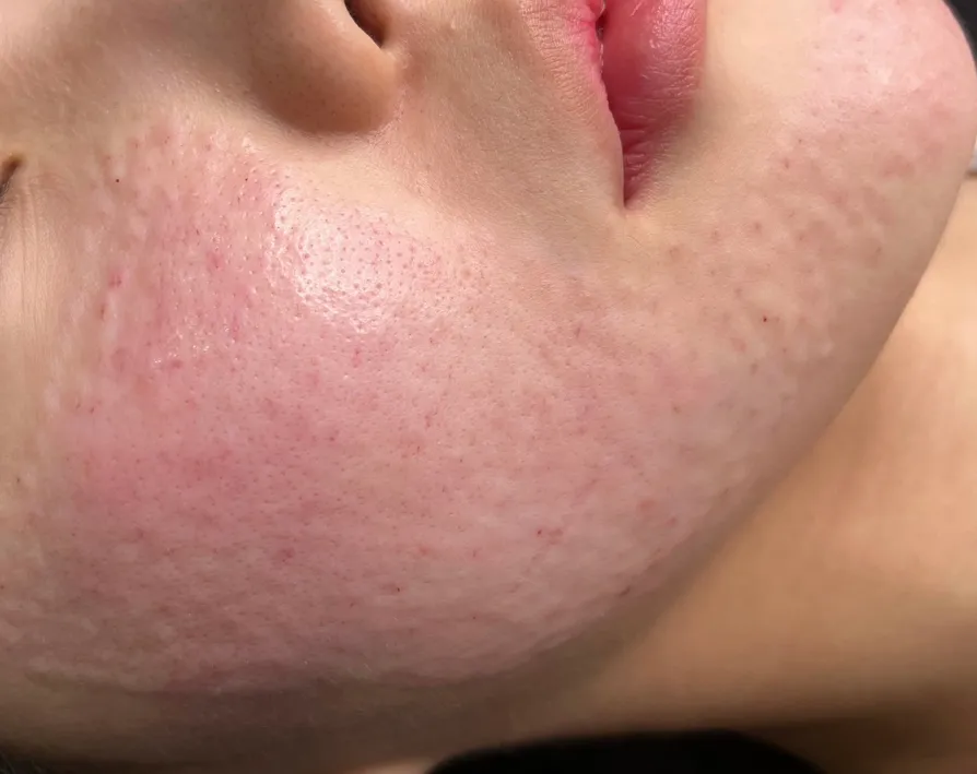 Small raised bumps on the cheek and jawline right after Rejuran injections at Time Return Clinic (12)