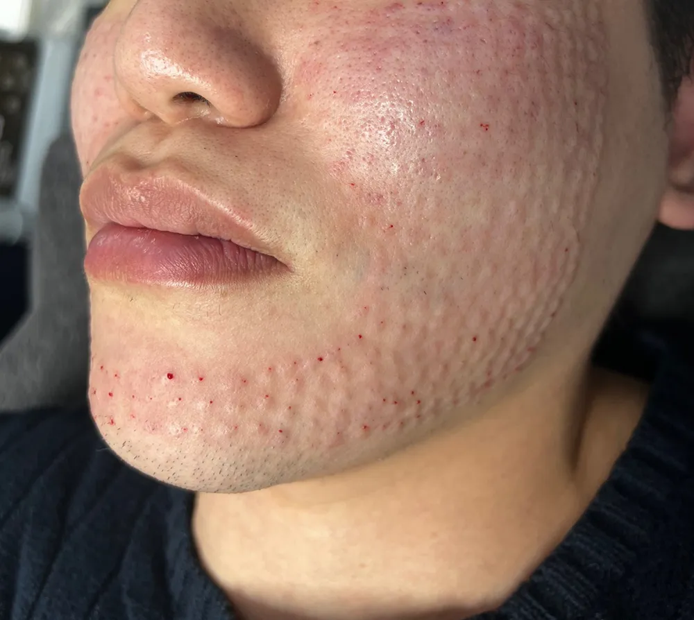 Small raised bumps on the cheek and jawline right after Rejuran injections at Time Return Clinic (13)