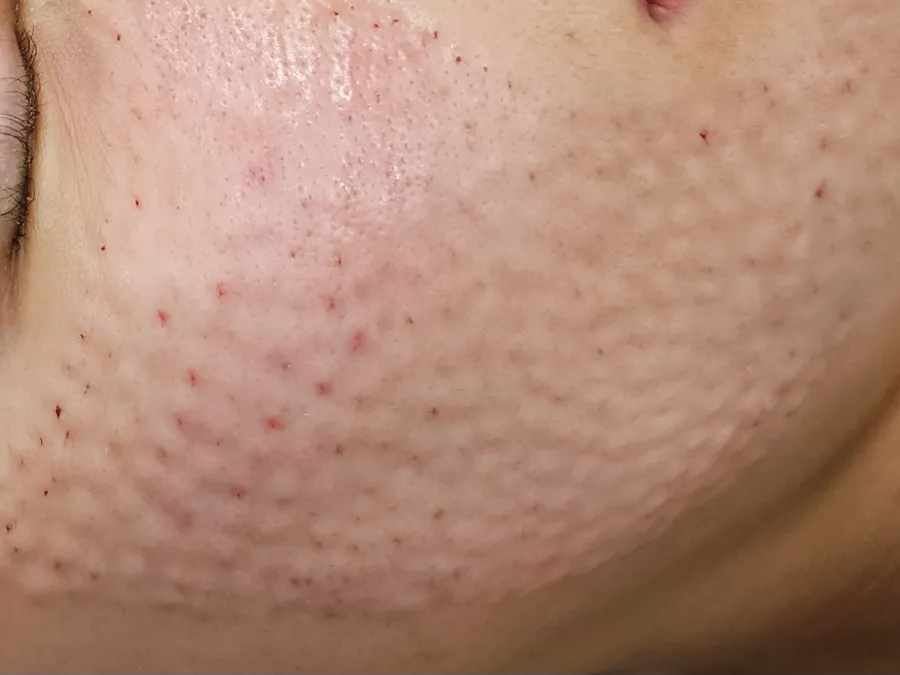 Small raised bumps on the cheek and jawline right after Rejuran injections at Time Return Clinic (14)