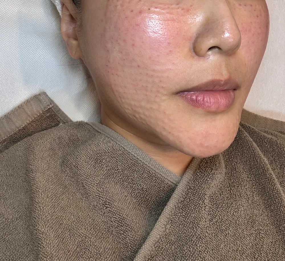 Small raised bumps on the cheek and jawline right after Rejuran injections at Time Return Clinic (15)