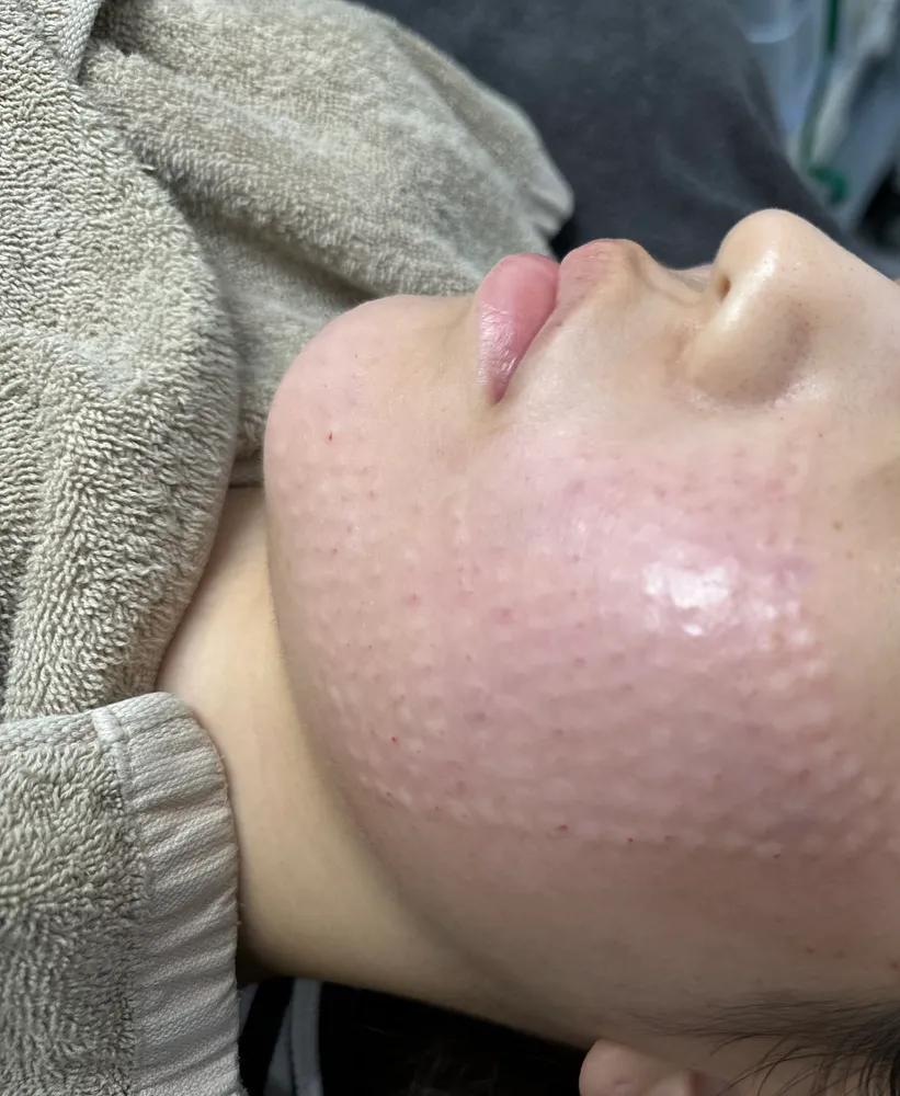 Small raised bumps on the cheek and jawline right after Rejuran injections at Time Return Clinic (16)