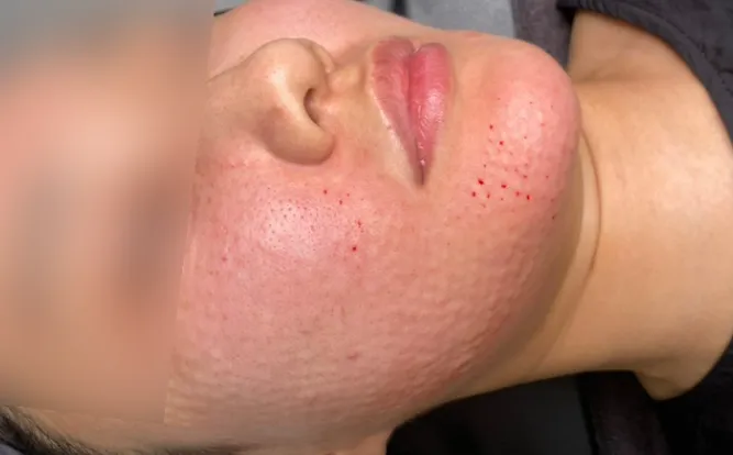 Small raised bumps on the cheek and jawline right after Rejuran injections at Time Return Clinic (17)