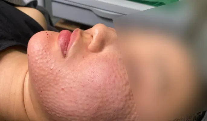 Small raised bumps on the cheek and jawline right after Rejuran injections at Time Return Clinic (18)