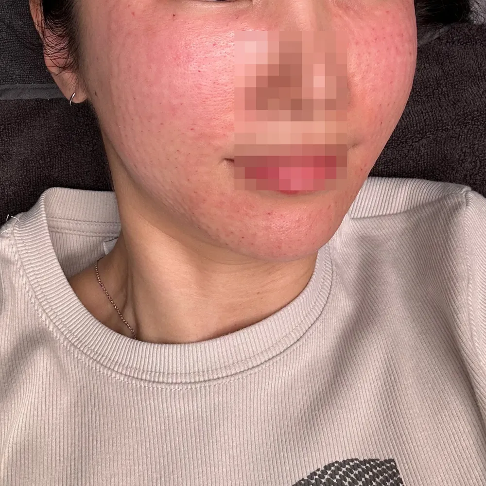Same patient, redness and small bumps right after Rejuran at Time Return Clinic (21)