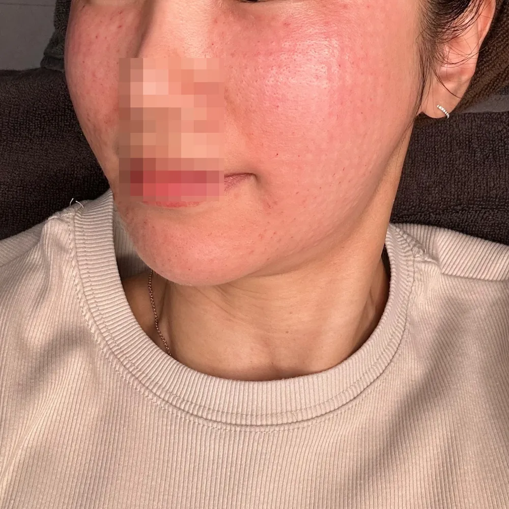 Same patient, redness and small bumps right after Rejuran at Time Return Clinic (22)