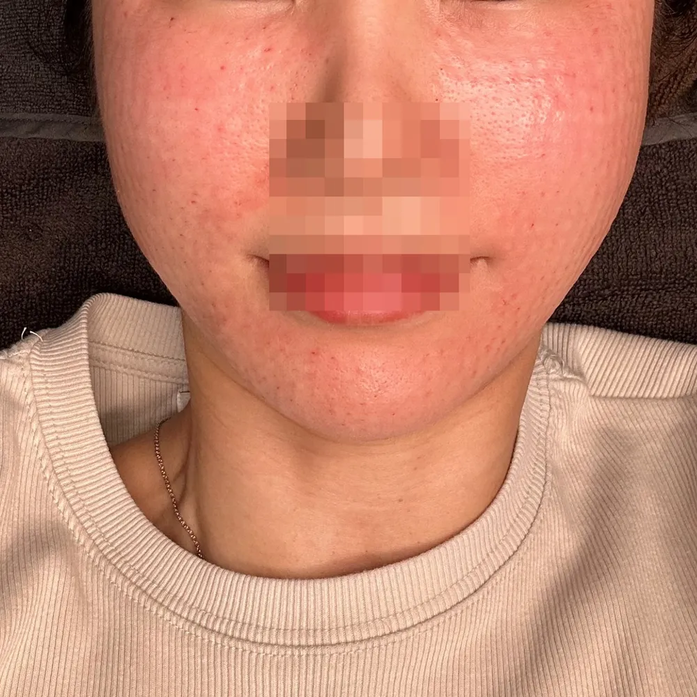 Same patient, redness and small bumps right after Rejuran at Time Return Clinic (23)